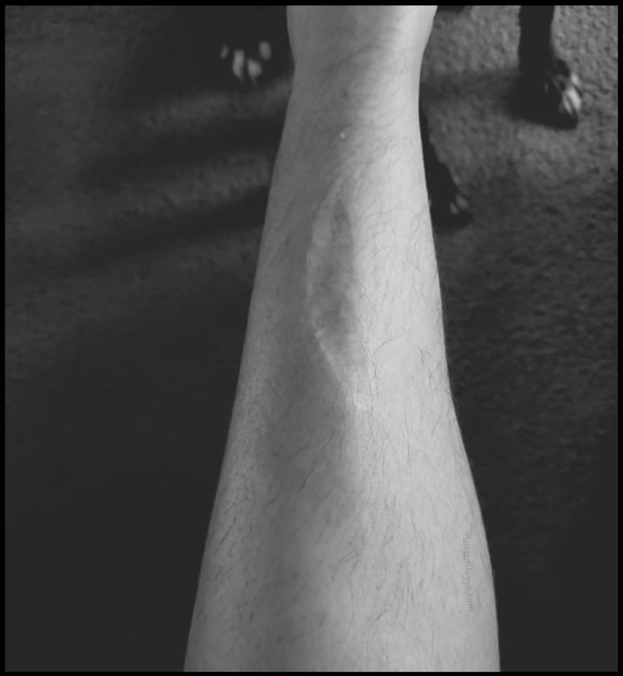 Panel 12: Image of a hairy shin with a very large but faded scar. The scar forms an indentation in the shin. There are puppy paws beyond in the background.